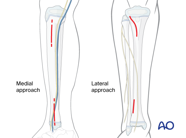 Approaches for MIPO in the pediatric tibial shaft fracture management