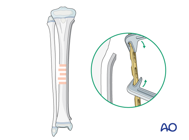 MIPO of a pediatric tibial shaft fracture - Contouring the plate