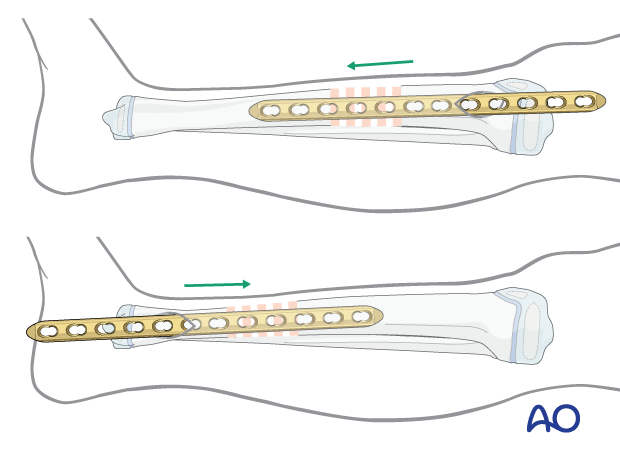 MIPO of a pediatric tibial shaft fracture - Direction of plate insertion