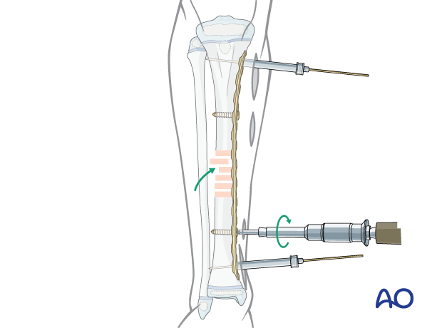 MIPO of a pediatric tibial shaft fracture - Reduction with insertion of conventional screws