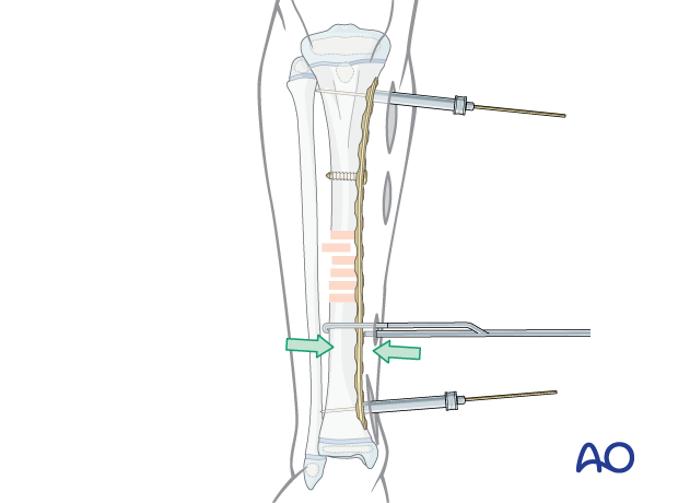 MIPO of a pediatric tibial shaft fracture - Reduction with a bone-holding clamp