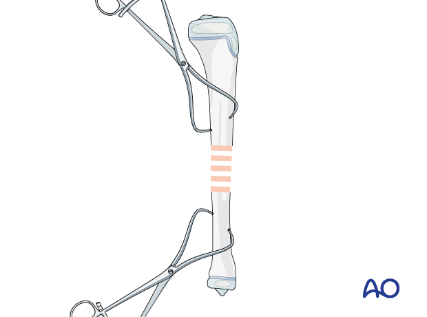 Plate fixation of a pediatric tibial shaft fracture - Reduction with bone reduction forceps