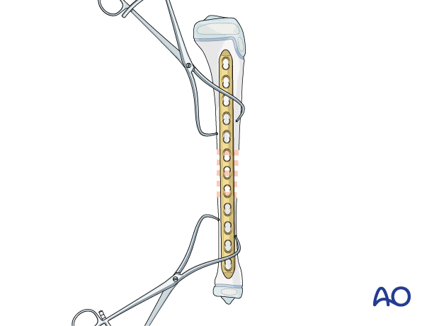 Plate fixation of a pediatric tibial shaft fracture - Application of the plate