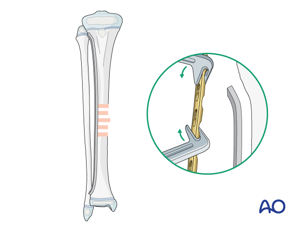 Plate fixation of a pediatric tibial shaft fracture - Plate contouring