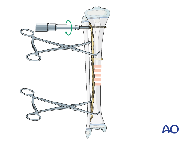 Plate fixation of a pediatric tibial shaft fracture - Insertion of first two screws in proximal fragment