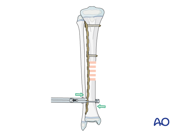 Plate fixation of a pediatric tibial shaft fracture – aligning the distal main fragment to the plate