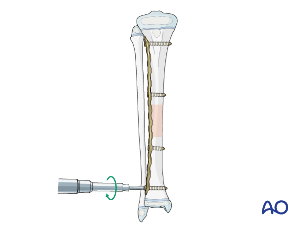 Plate fixation of a pediatric tibial shaft fracture - Insertion of screws in distal fragment