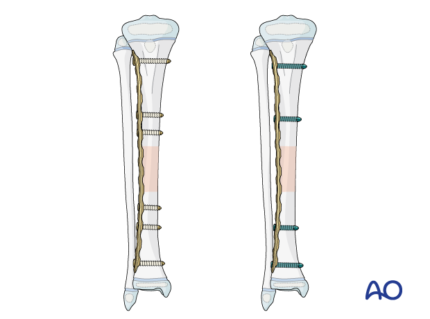 Plate fixation of a pediatric tibial shaft fracture - Final construct