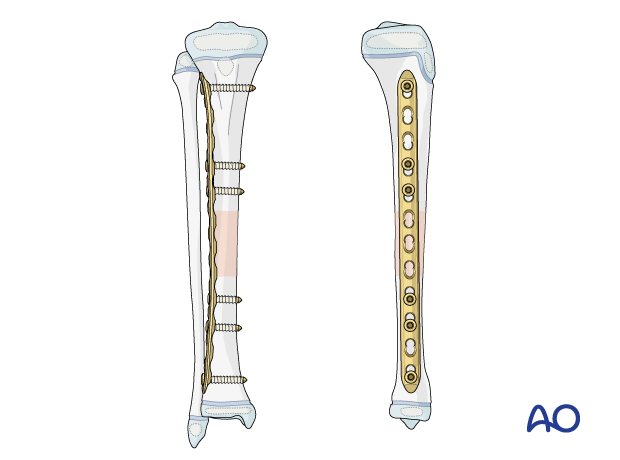 Plate fixation of a pediatric tibial shaft fracture 