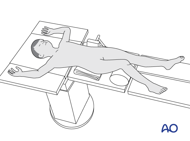 Supine position of a pediatric patient for surgery of the tibial shaft