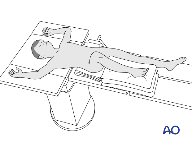 Supine patient position with the injured leg on a stack of towels