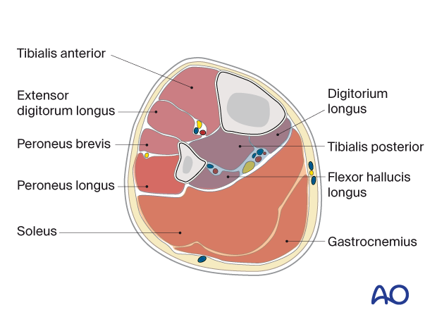 Cross-section of the pediatric lower leg with its four compartments and labels to all muscles