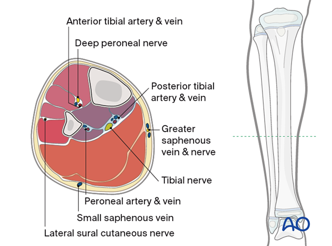 Compartment syndrome (lower limb)