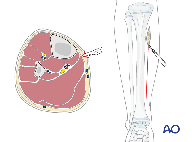 Posteromedial skin incision in the pediatric lower leg