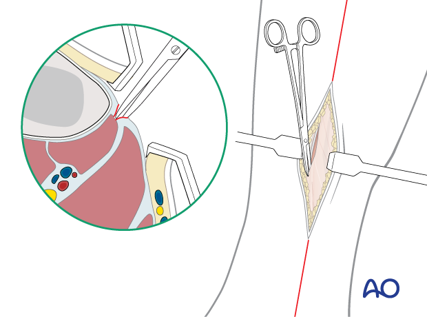 Dissection of the deep posterior compartment fascia in the pediatric lower leg