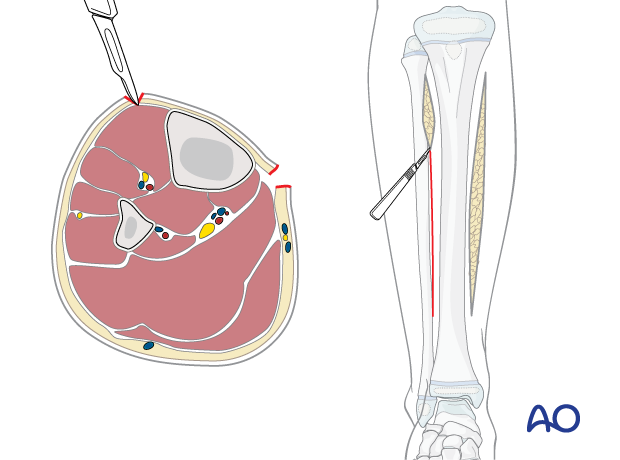 Anterolateral skin incision in the pediatric lower leg