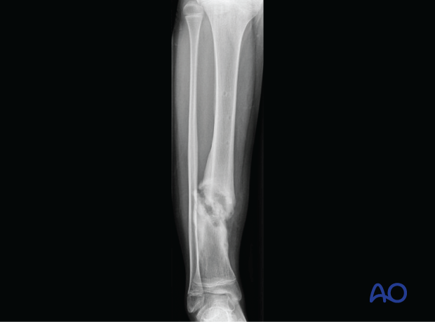 X-ray showing nonunion of a pediatric tibial shaft fracture