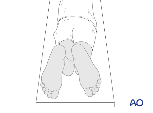 malunion of the tibial shaft can be seen with external rotation of the right foot