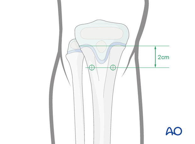 Entry points for antegrade elastic nailing of the pediatric tibia