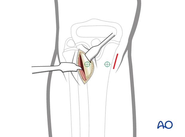 Subcutaneous dissection of the lateral side of the pediatric proximal tibia for insertion of an elastic nail
