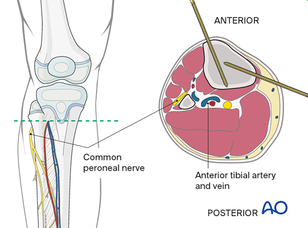 Safe zone for pin insertion in the proximal third of the tibia