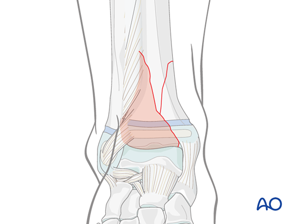 Fracture of the pediatric distal tibia with a large anterolateral fragment