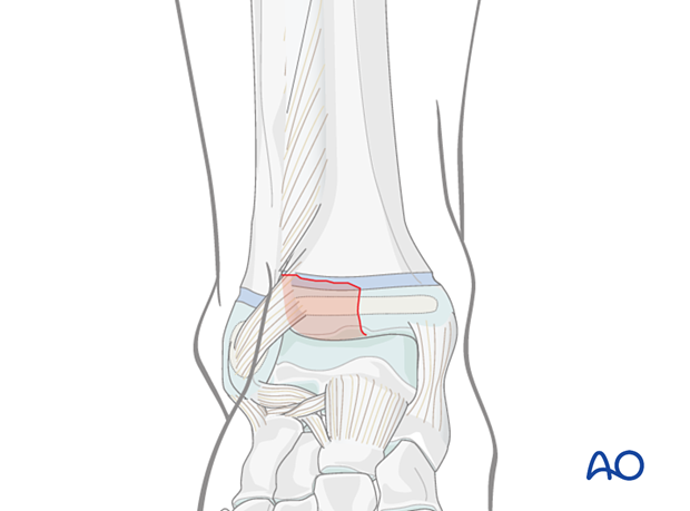Fracture of the pediatric distal tibia with a small anterolateral fragment