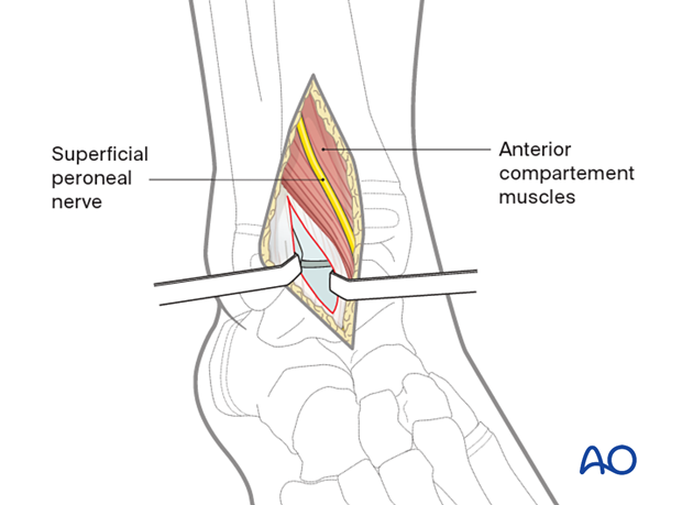 Surgical dissection for the anterolateral approach to the pediatric distal tibia