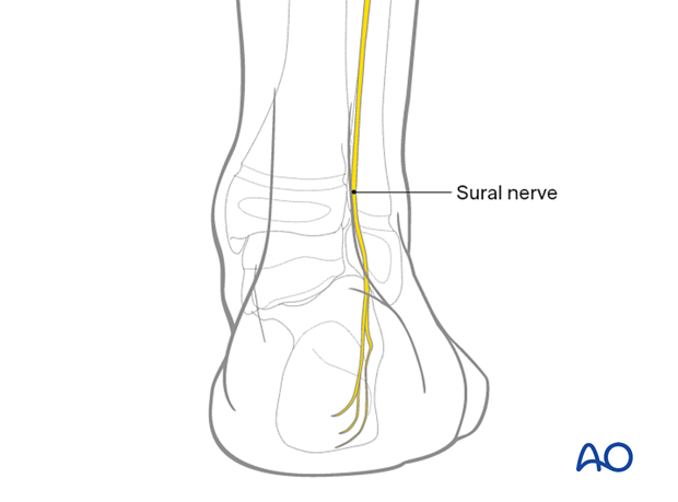 Anatomy of the sural nerve in the pediatric distal tibia and ankle
