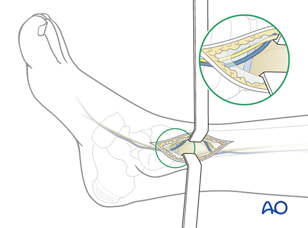 Surgical dissection of a minimally invasive approach for plating of the pediatric distal tibia