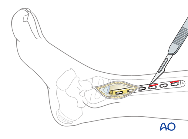Proximal stab incisions of a minimally invasive approach for plating of the pediatric distal tibia
