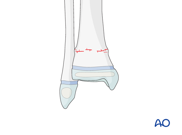 Torus/buckle fracture of the pediatric metaphyseal distal tibia