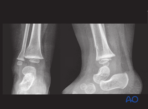 X-rays showing a buckle fracture of the distal tibia and fibula in an 18-month-old patient
