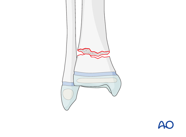 Complete simple fracture of the pediatric metaphyseal distal tibia