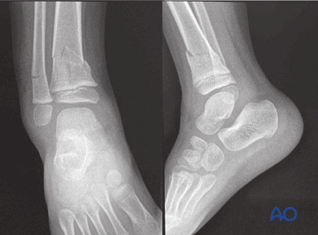 X-rays showing a simple metaphyseal distal tibial fracture with an associated buckle fracture of the fibula in a 4-year-old patient