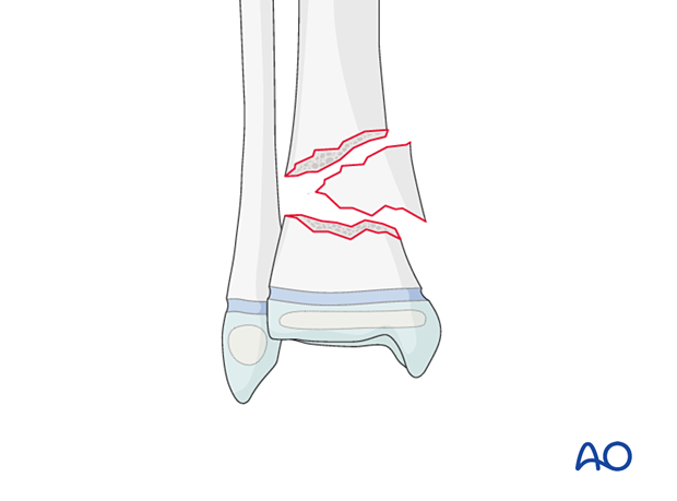 Complete multifragmentary fracture of the pediatric metaphyseal distal tibia
