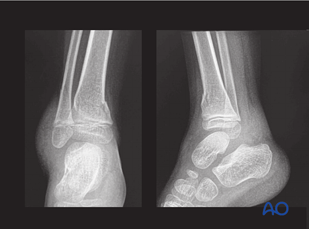 X-rays showing a multifragmentary metaphyseal distal tibial fracture in a 4-year-old patient