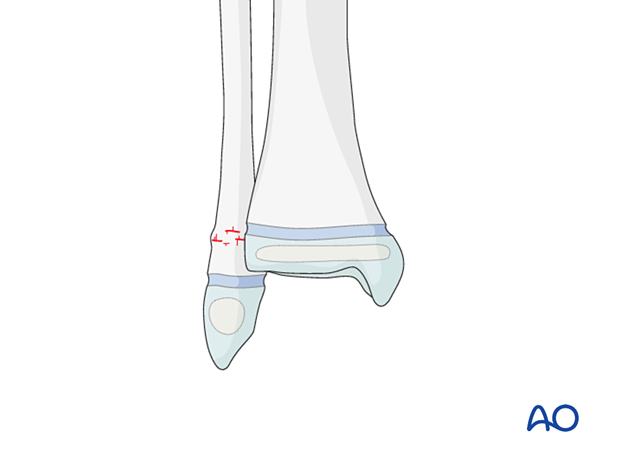 Torus/buckle fracture of the pediatric metaphyseal distal fibula
