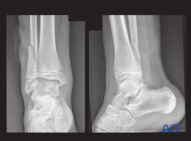 X-rays showing a metaphyseal distal fibular fracture in a 10-year-old patient