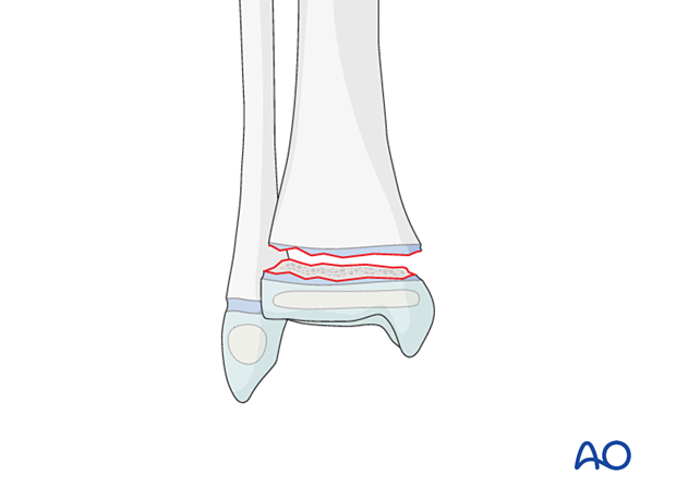 Salter-Harris I fracture of the pediatric distal tibia