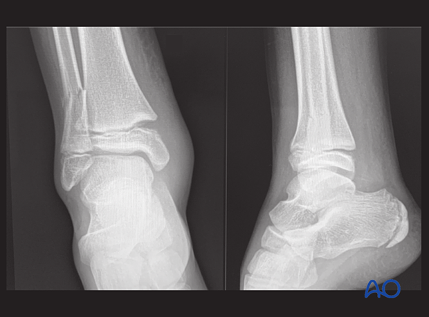 X-rays showing a Salter-Harris I distal tibial fracture with an associated metaphyseal fracture of the distal fibula in a 13-year-old patient