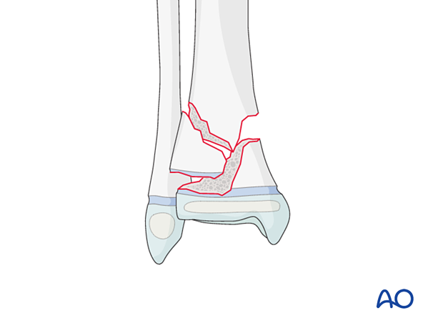 Multifragmentary Salter-Harris II fracture of the pediatric distal tibia