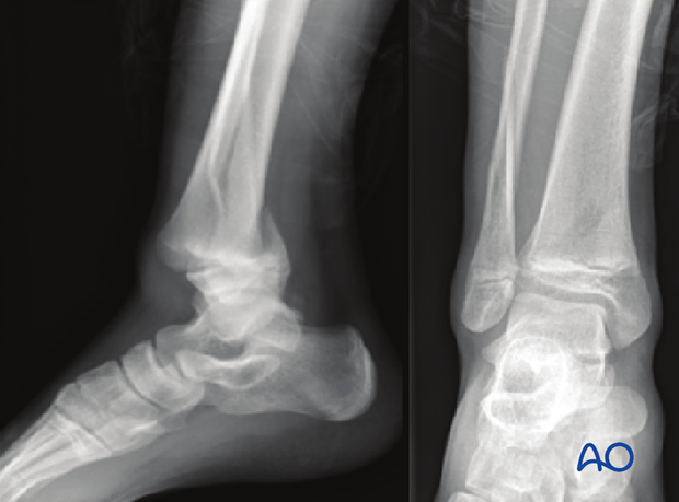 Lateral and mortise x-ray of an isolated simple Salter-Harris II distal tibial fracture with a posterior metaphyseal fragment