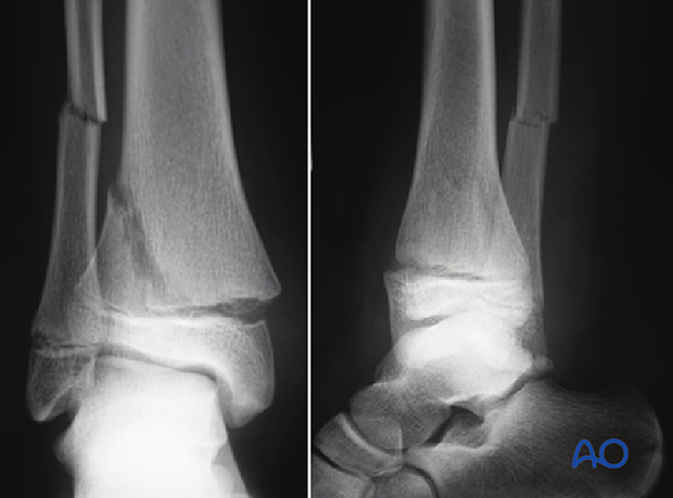 Epiphysiolysis With Metaphyseal Wedge Salter Harris Ii Of The Distal Tibia