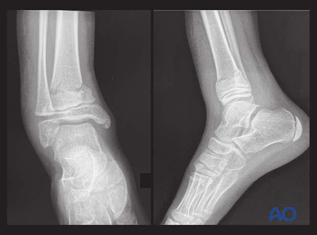 X-rays showing a multifragmentary Salter-Harris II distal tibial fracture with an associated Salter-Harris I fracture of the distal fibula in a 9-year-old patient