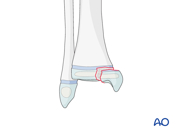 Salter-Harris III fracture of the pediatric distal tibia