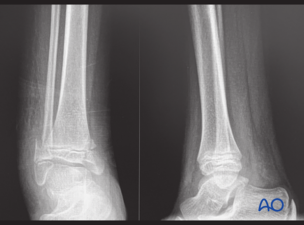 X-rays showing a Salter-Harris IV distal tibial fracture with an associated simple metaphyseal fracture of the distal fibula in a 9-year-old patient