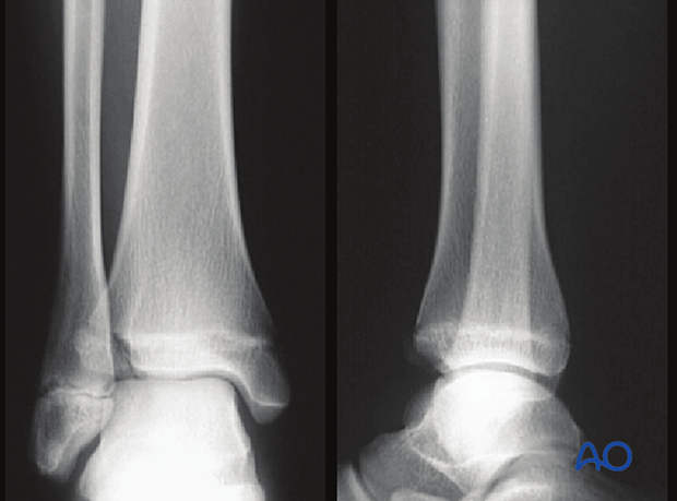 Lateral and AP x-rays of a Tillaux fracture of the pediatric distal tibia