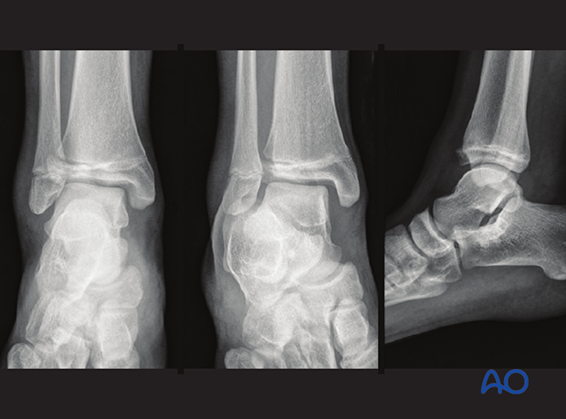Lateral, mortise, and AP x-rays of a Tillaux fracture of the pediatric distal tibia
