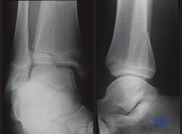 X-ray showing a triplane fracture of the pediatric distal tibia